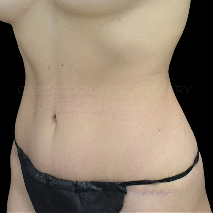 Tummy-Tuck-Case--10208 | After Tummy Tuck