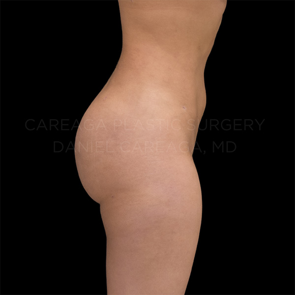 Brazilian-Butt-Lift-Case--12049 | After Brazilian Butt Lift