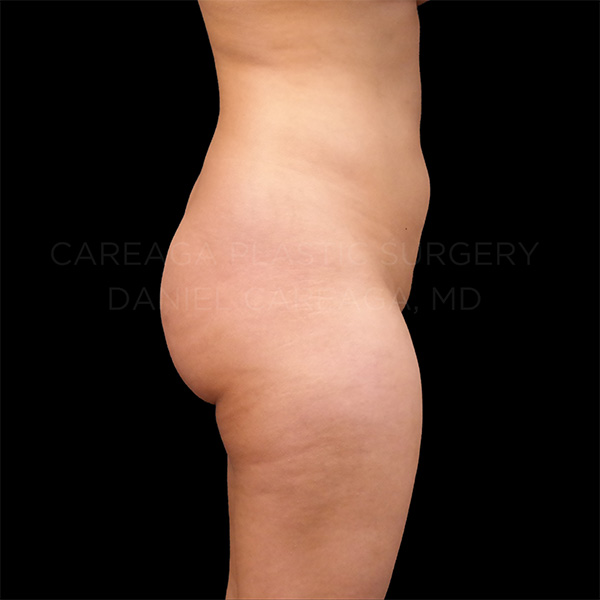 Brazilian-Butt-Lift-Case--12049 | Before Brazilian Butt Lift