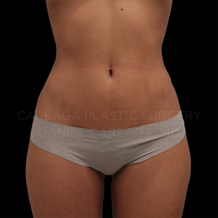 Liposuction-Case--17873 | After Liposuction