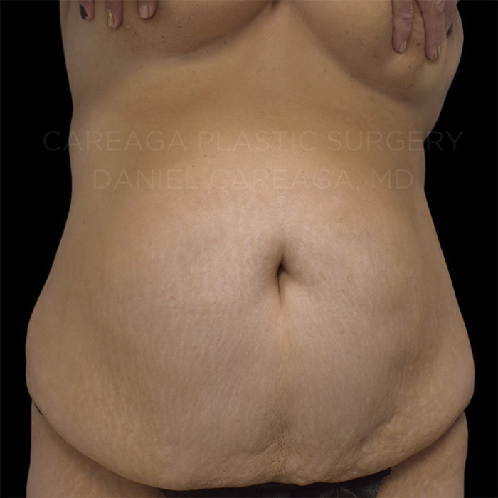 Tummy-Tuck-Case--20061 | Before Tummy Tuck