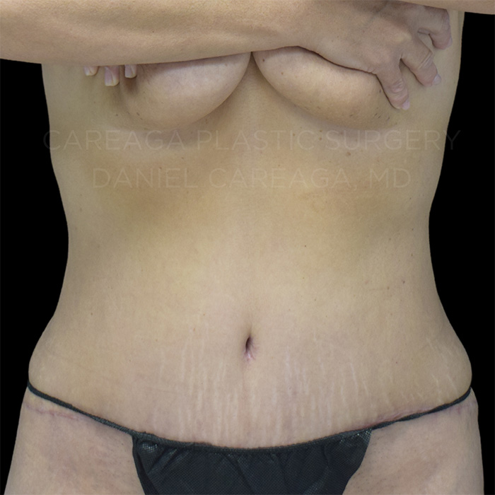 Tummy-Tuck-Case--20061 | After Tummy Tuck