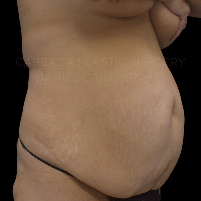 Tummy Tuck Case #20061 before, view 3