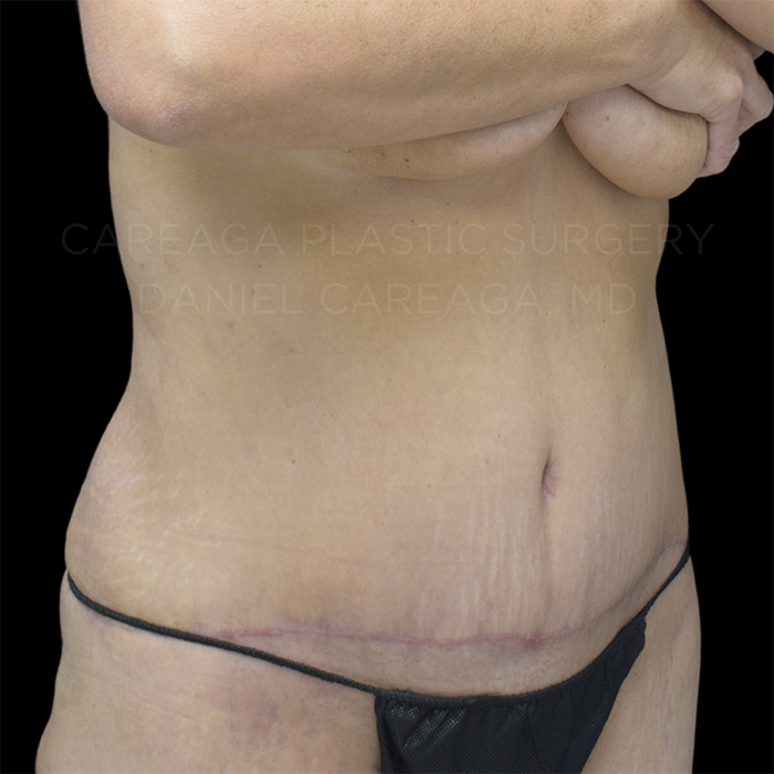 Tummy Tuck Case #20061 after, view 3