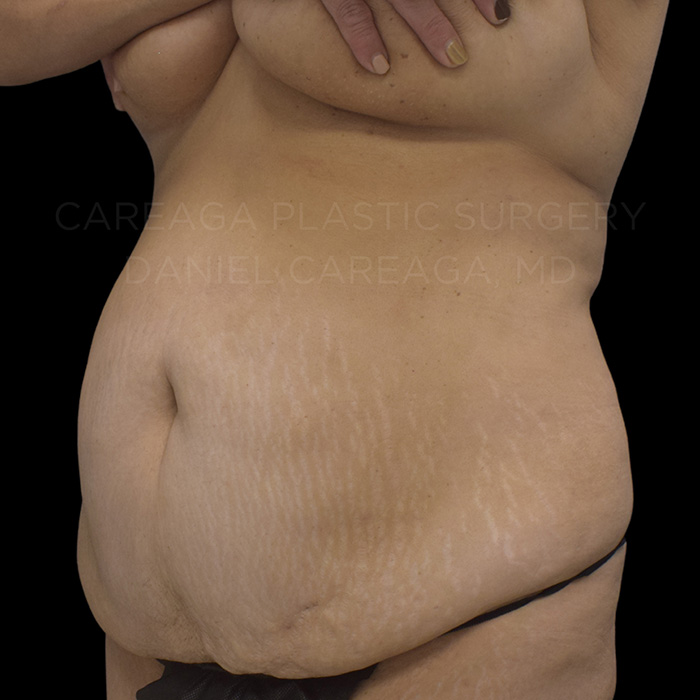 Tummy Tuck Case #20061 before, view 2