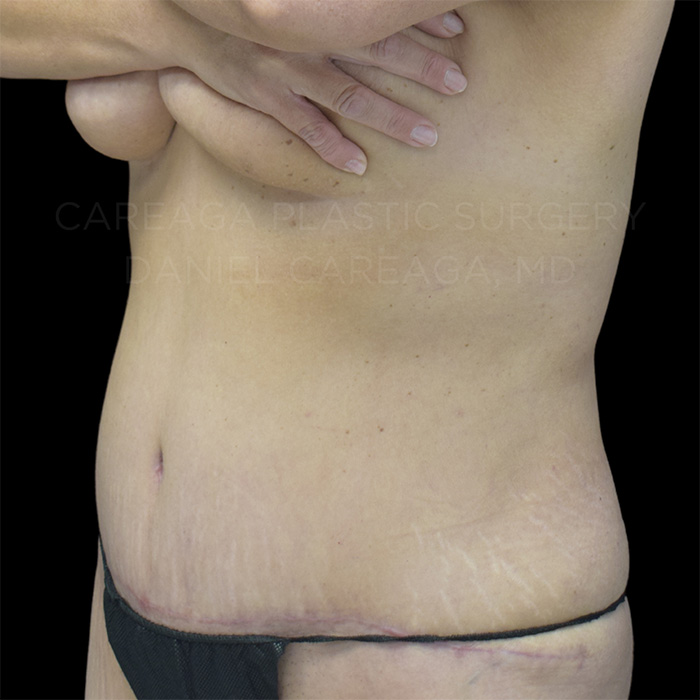Tummy Tuck Case #20061 after, view 2