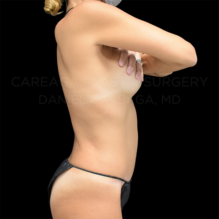 Tummy Tuck Case #22796 after, view 2