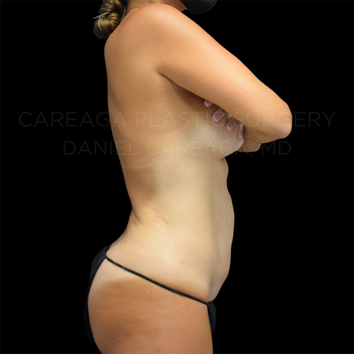 Tummy Tuck Case #22796 before, view 2