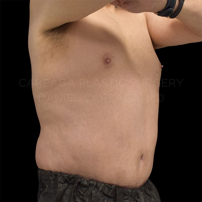 Tummy-Tuck-Case--23131 | After Tummy Tuck