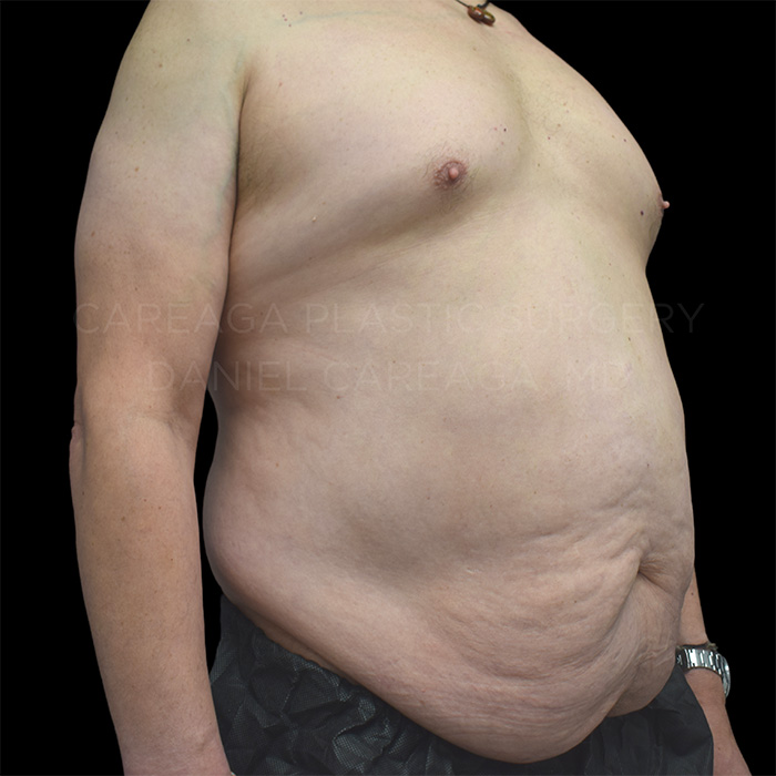 Tummy-Tuck-Case--23131 | Before Tummy Tuck