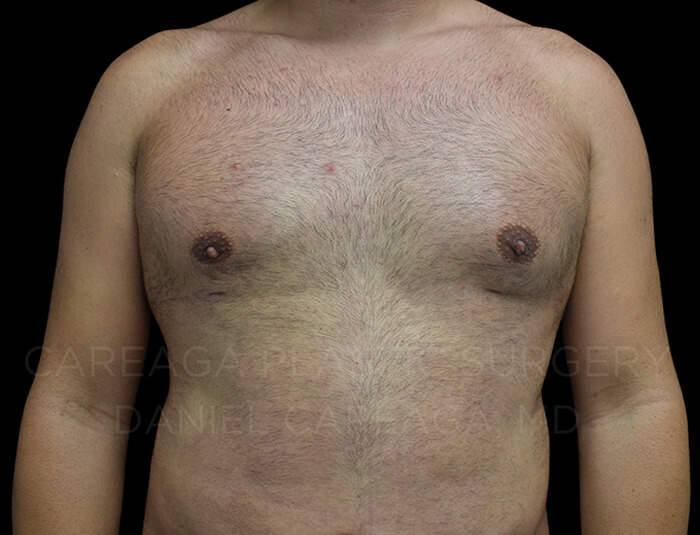Gynecomastia-Case-24249 | After Gynecomastia