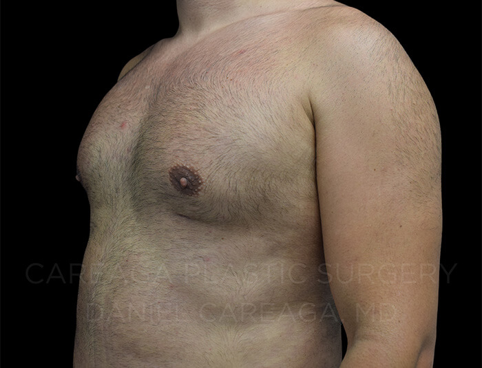 Gynecomastia Case 24249 after, view 2