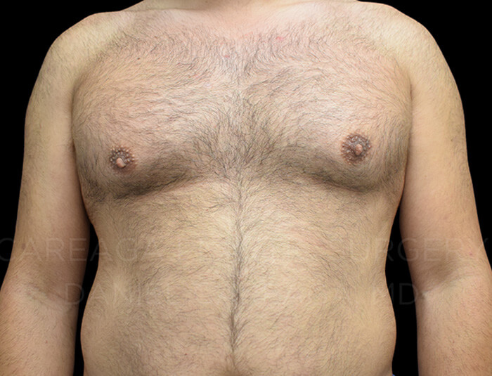 Gynecomastia-Case-24249 | Before Gynecomastia