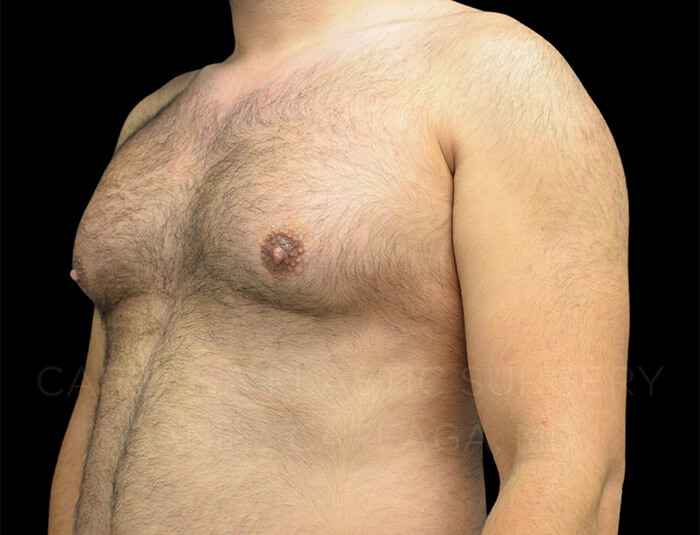 Gynecomastia Case 24249 before, view 2