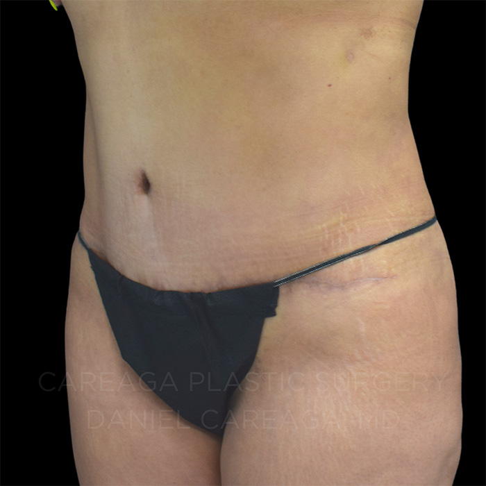Tummy Tuck Case #24908 after, view 2