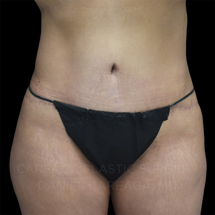 Tummy-Tuck-Case--24908 | After Tummy Tuck