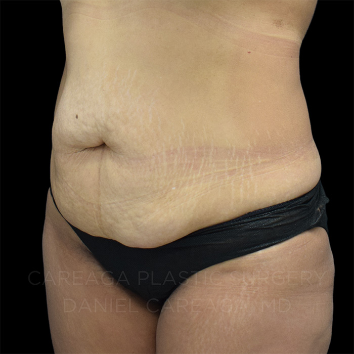 Tummy Tuck Case #24908 before, view 2
