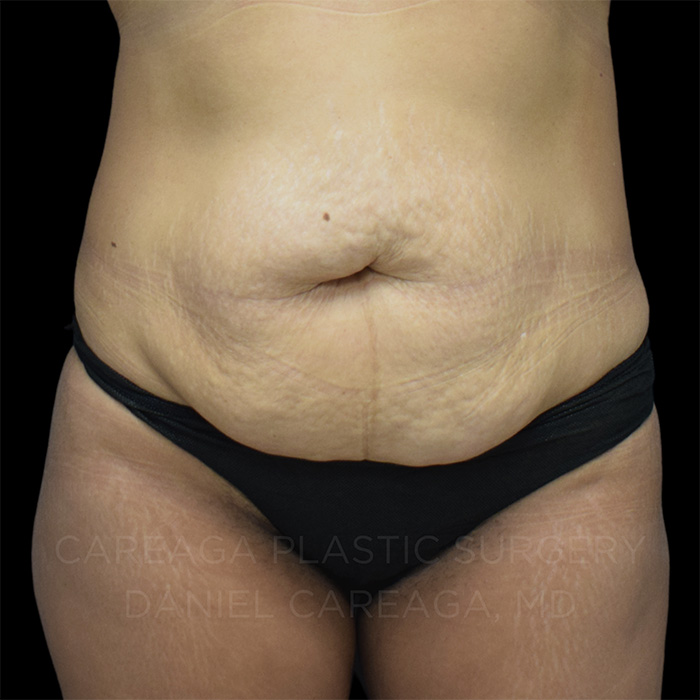 Tummy-Tuck-Case--24908 | Before Tummy Tuck