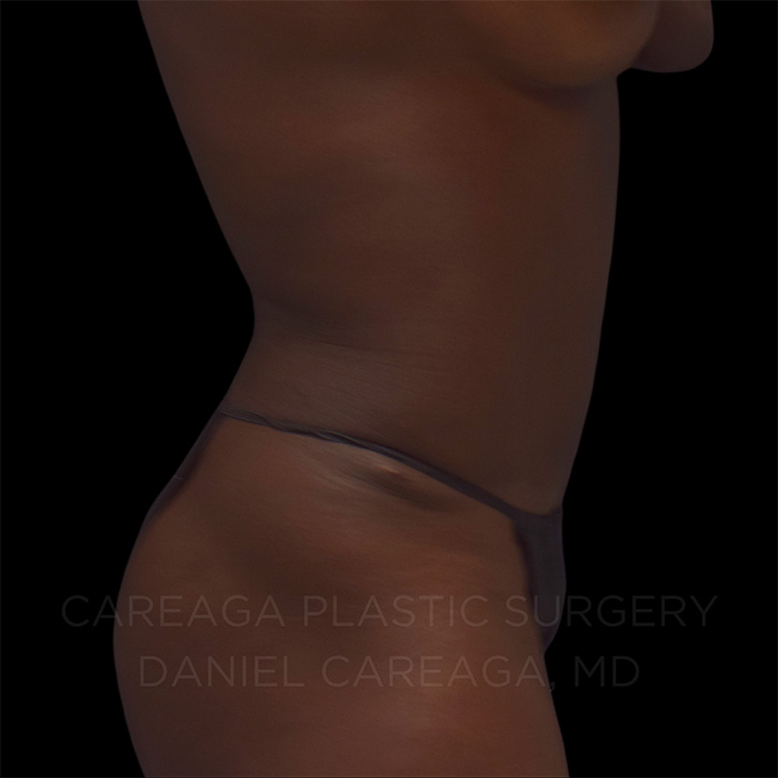 Tummy Tuck Case #25252 after, view 3