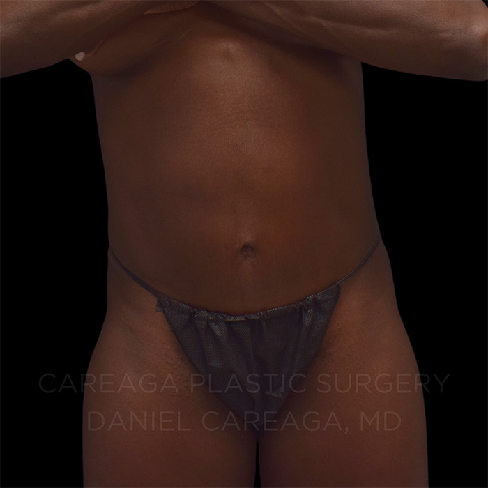 Tummy-Tuck-Case--25252 | After Tummy Tuck