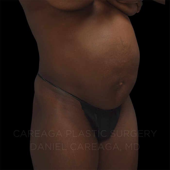 Tummy Tuck Case #25252 before, view 2