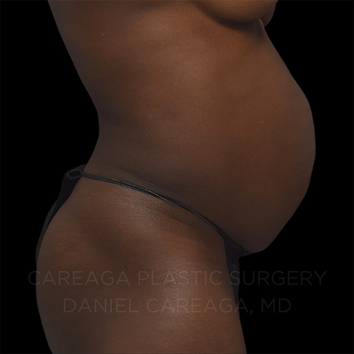 Tummy Tuck Case #25252 before, view 3