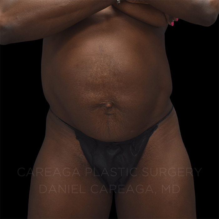 Tummy-Tuck-Case--25252 | Before Tummy Tuck