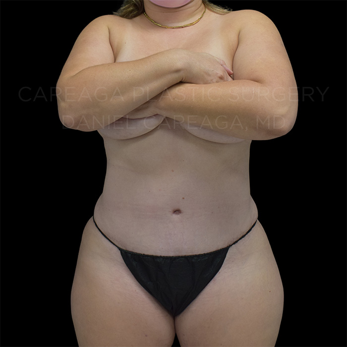 Tummy-Tuck-Case--25762 | After Tummy Tuck