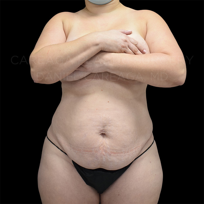 Tummy-Tuck-Case--25762 | Before Tummy Tuck