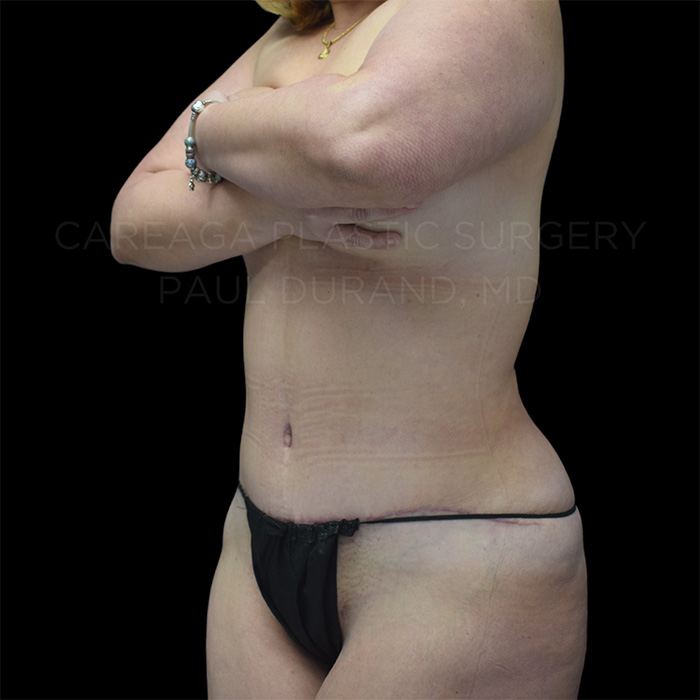 Tummy Tuck Case #26746 after, view 2