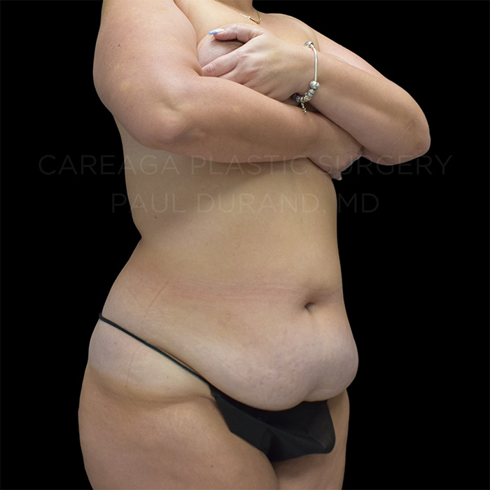 Tummy Tuck Case #26746 before, view 3