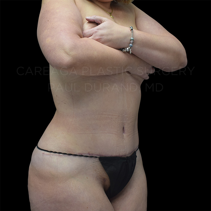 Tummy Tuck Case #26746 after, view 3
