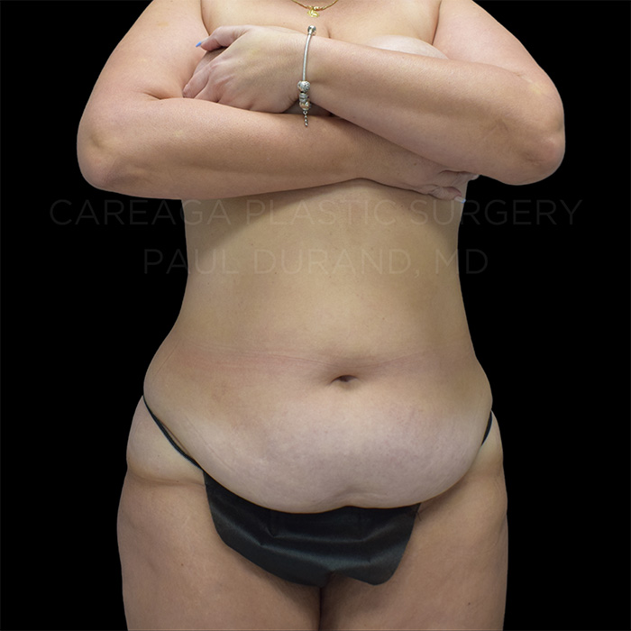 Tummy-Tuck-Case--26746 | Before Tummy Tuck