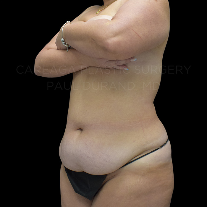 Tummy Tuck Case #26746 before, view 2