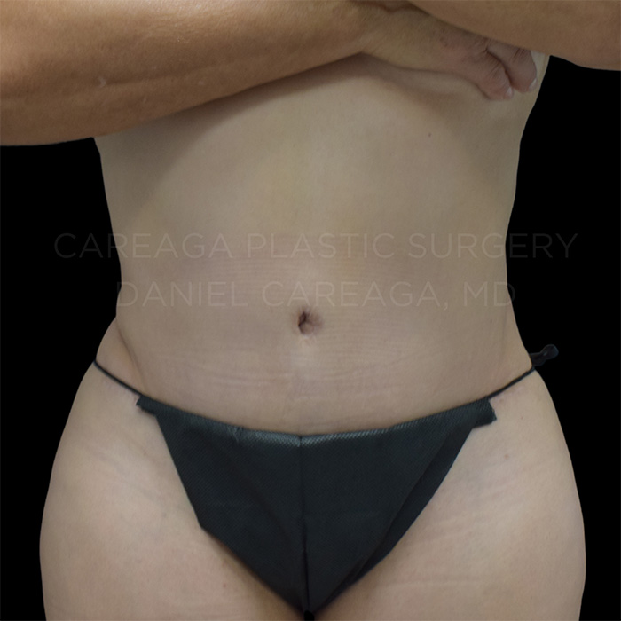 Tummy-Tuck-Case--26798 | After Tummy Tuck