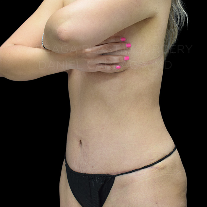 Tummy Tuck Case #27793 after, view 3