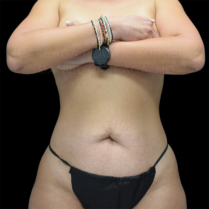 Tummy-Tuck-Case--27793 | Before Tummy Tuck