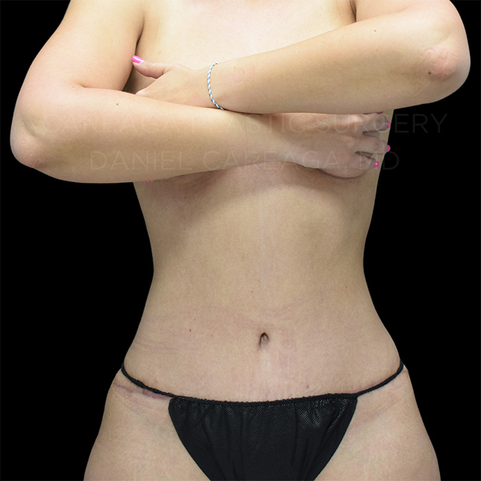 Tummy-Tuck-Case--27793 | After Tummy Tuck