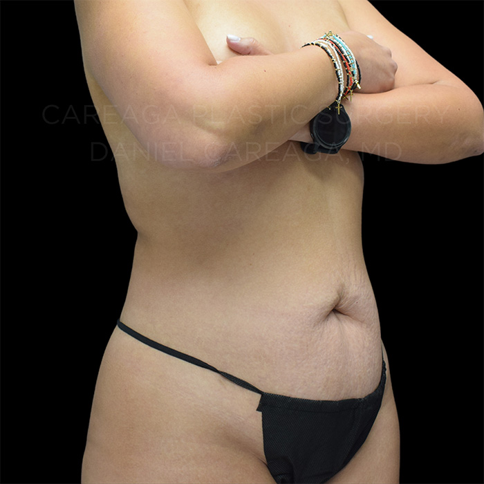 Tummy Tuck Case #27793 before, view 2