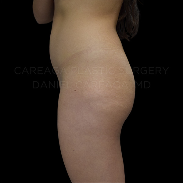 Brazilian-Butt-Lift-Case--29457 | Before Brazilian Butt Lift