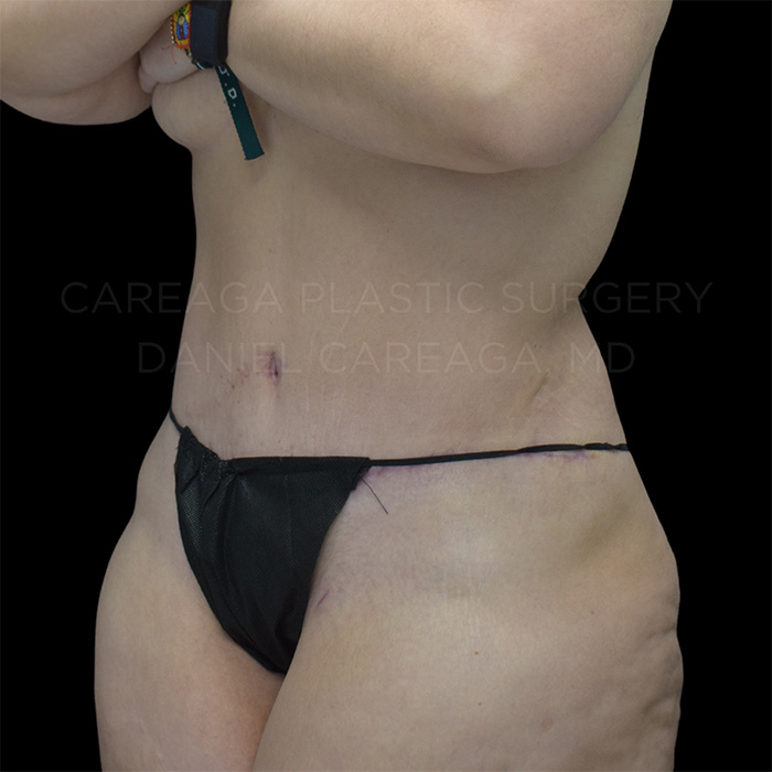 Tummy Tuck Case #29620 after, view 2