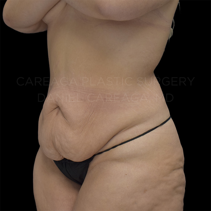 Tummy Tuck Case #29620 before, view 2