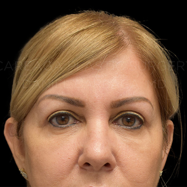Blepharoplasty-Case--29772 | After Blepharoplasty