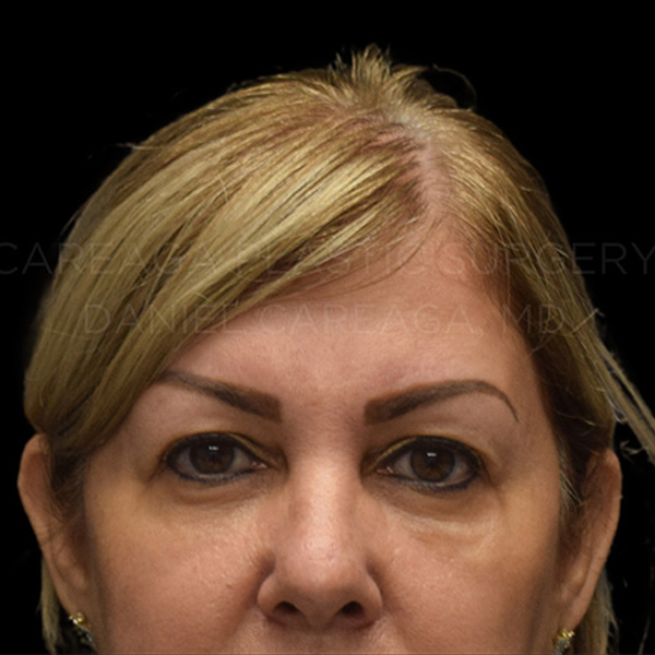 Blepharoplasty-Case--29772 | Before Blepharoplasty