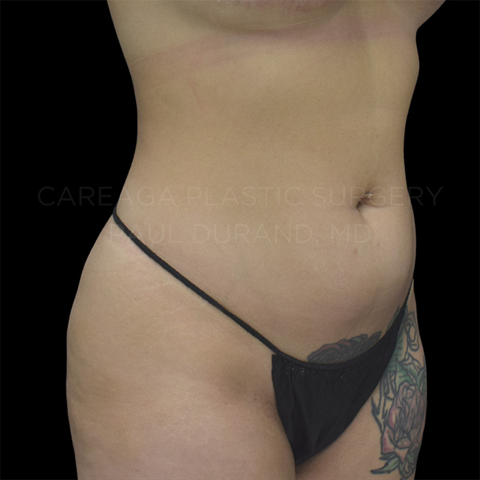 Liposuction-Case--30355 | Before Liposuction