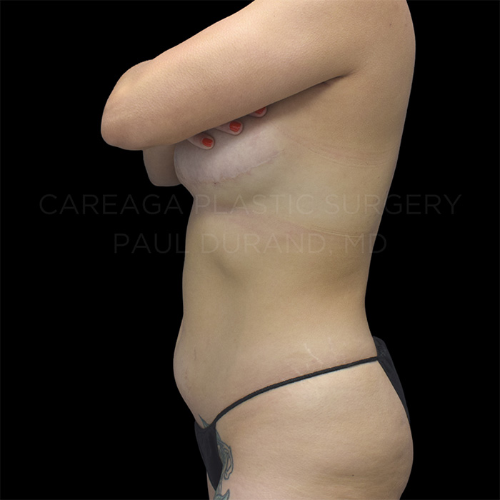 Liposuction Case #30355 before, view 4