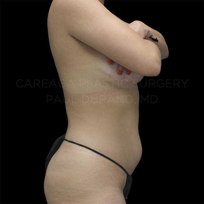 Liposuction Case #30355 before, view 2