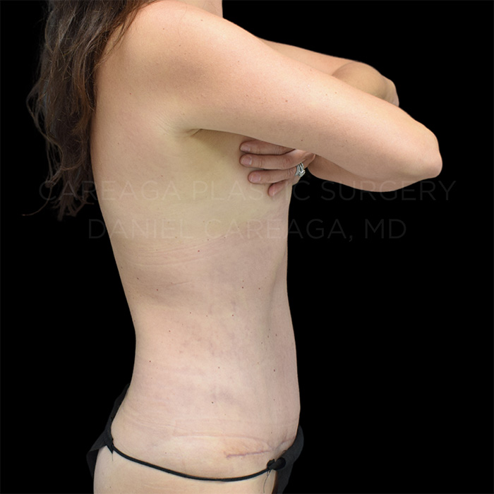 Tummy-Tuck-Case--30370 | After Tummy Tuck