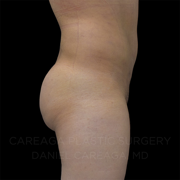 Brazilian-Butt-Lift-Case--30596 | After Brazilian Butt Lift