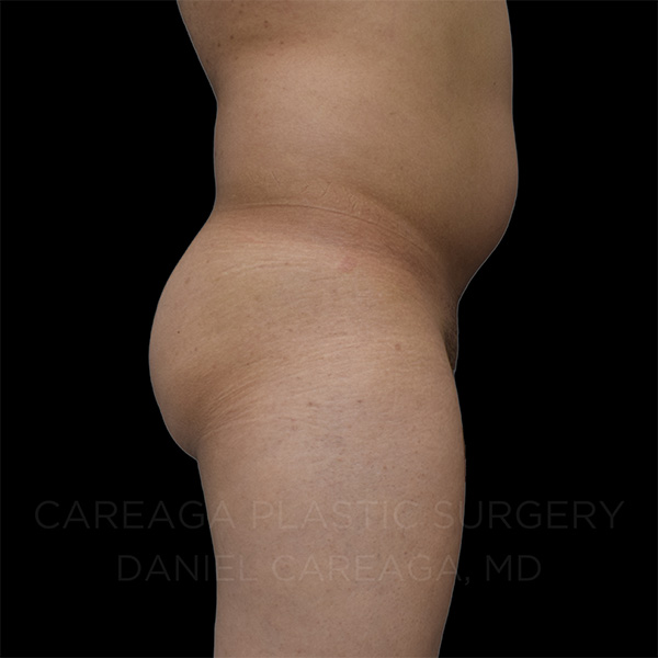 Brazilian-Butt-Lift-Case--30596 | Before Brazilian Butt Lift